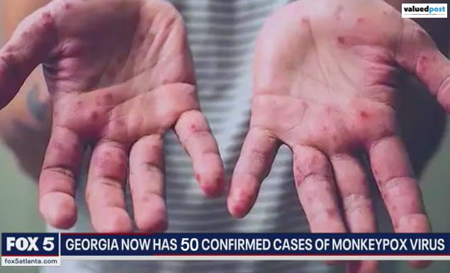 Monkeypox Dallas: The County Ran Out of Monkeypox Vaccines as Cases have Risen